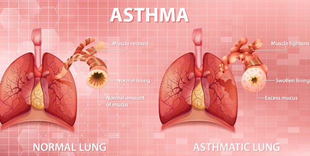 Allergic And Non Allergic Asthma 10 Facts About This Condition You Must